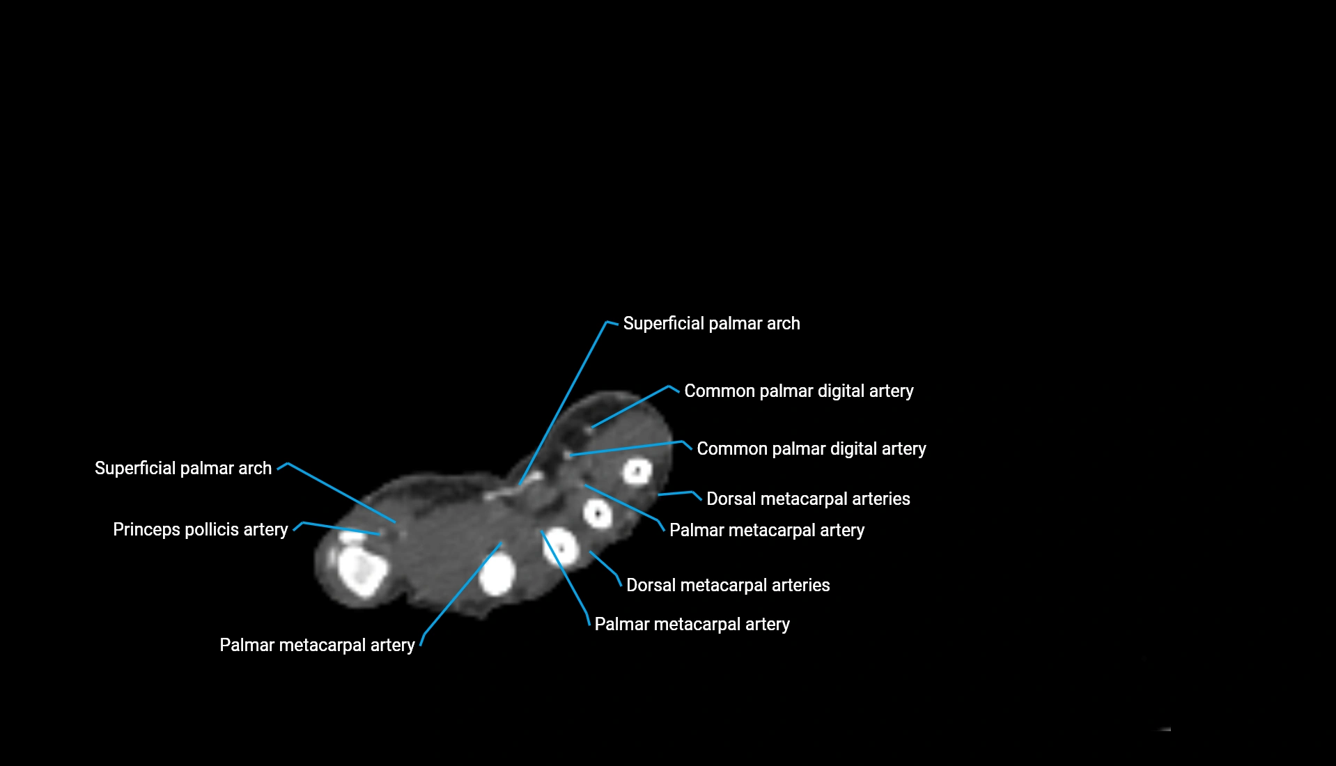 CTA upper limb axial cross sectional anatomy labelled image 60 (2).webp